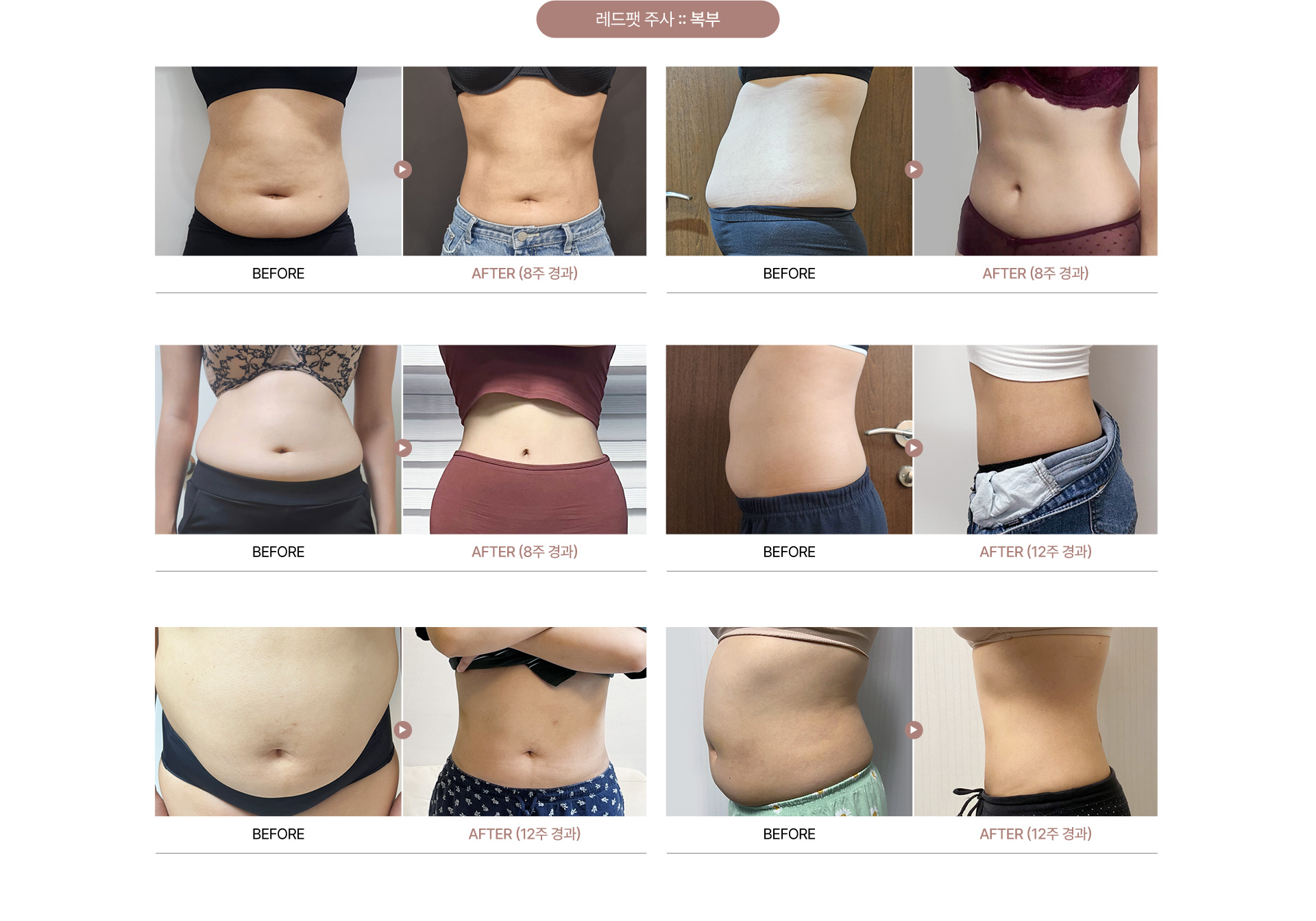 청담쟈스민라인의원 레드팻주사 전후사진