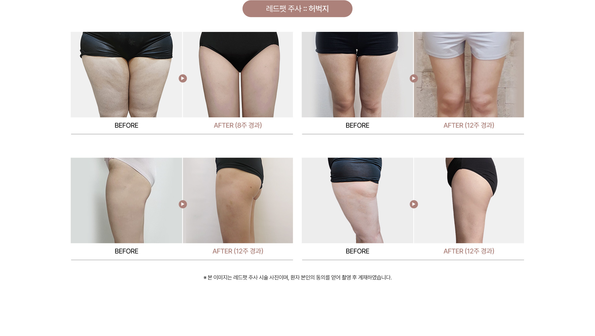 청담쟈스민라인의원 레드팻주사 전후사진