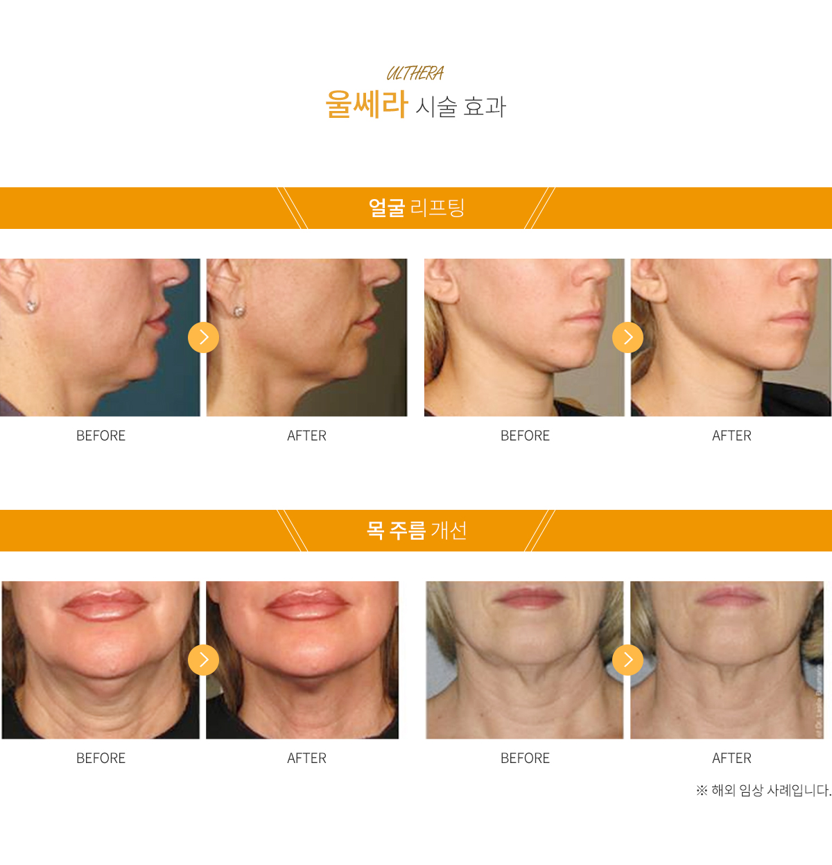  전후사진